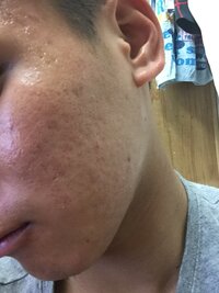 ２０歳の大学生 男 です 自分に自信がありません 原因はにきび跡 クレー Yahoo 知恵袋