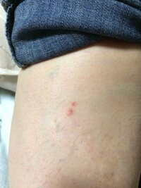 刺され た 跡 ダニ