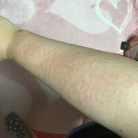 レーザー脱毛をしたあとこのようになりました 痒みがすごいです 赤くてぼこぼ Yahoo 知恵袋