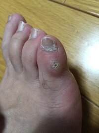 タコ 魚の目 靴のサイズが合わない靴を履き続けて半年 足が痛くてたま Yahoo 知恵袋