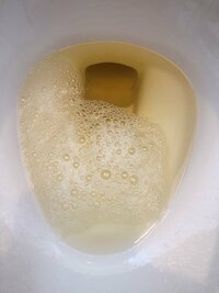 尿が泡だつのですが 何かの病気でしょうか 一応画像を貼って Yahoo 知恵袋
