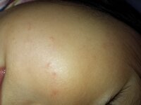この画像は水いぼでしょうか 九ヶ月の赤ちゃんの顔です 病院にはい Yahoo 知恵袋