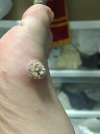 治し 方 血豆