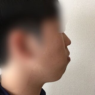この顔はアデノイドでしょうか できれば治し方も教えてください 歯並び Yahoo 知恵袋