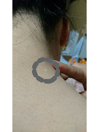 右の首の肩寄りりにしこり を見つけました 痛くもないし動きません 皮 Yahoo 知恵袋