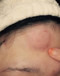 たんこぶってどれくらいで治りますか さっき下を向いて歩いていて柱 Yahoo 知恵袋