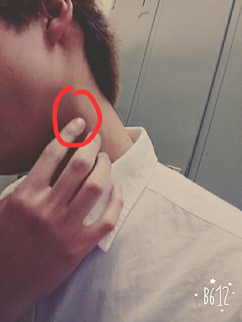 首にしこりみたいなのができました。 - 触ると痛みがありグリグリ動い 