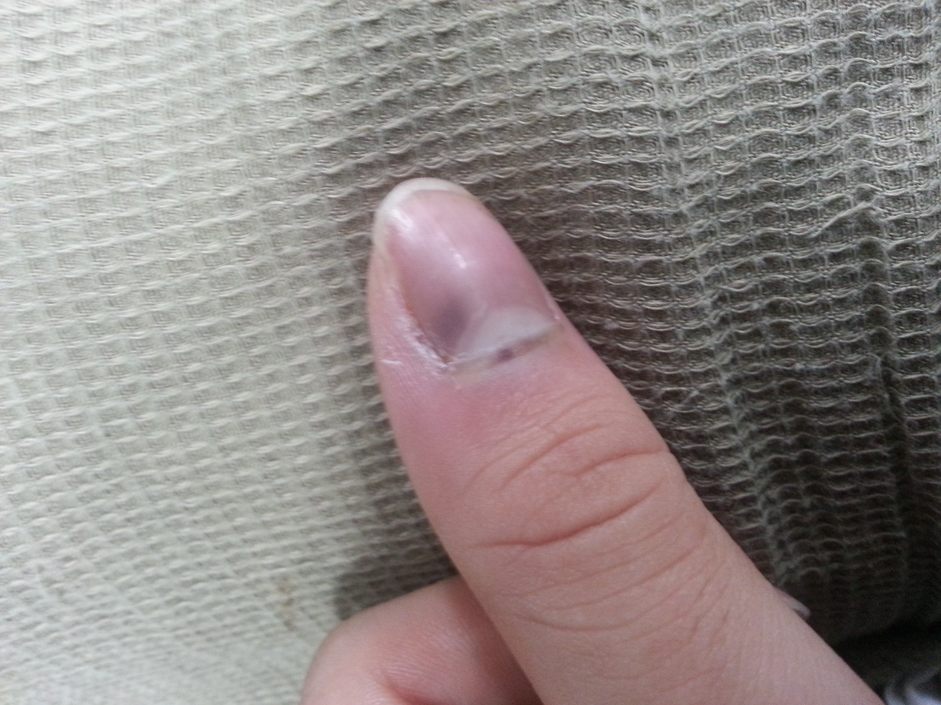 紫っぽく 爪 に関するq A Yahoo 知恵袋