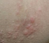 内腿 足の付け根にブツブツが出来ました 暑くなるとかゆいで Yahoo 知恵袋