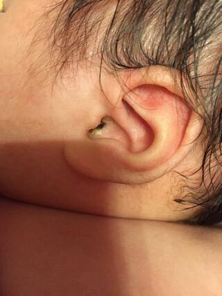 赤ちゃん 耳垢 耳垢が臭い 黒い 耳垢が招く病気やトラブルを専門医が解説