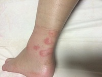 これはなんの虫刺されでしょうか 病院に行ってスチブロン軟膏0 05 とい Yahoo 知恵袋