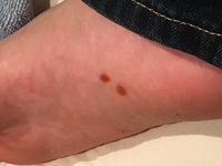 足の裏に赤い斑点みたいなのができたんですけどなんなんでしょうか 水虫 Yahoo 知恵袋