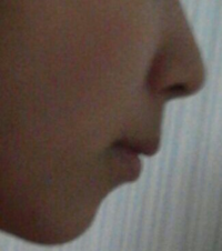 中学3年生男子です 僕は多分アデノイド顔貌です アデノイド顔貌の治し方って Yahoo 知恵袋