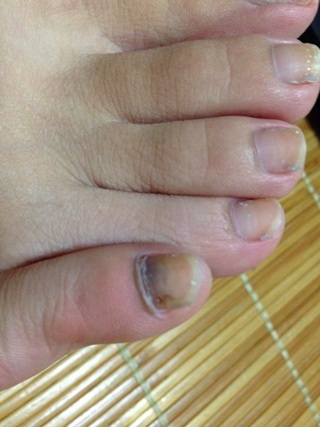 協定 飛躍 すぐに 足 小指 爪 黒い 治す Taonta Biz