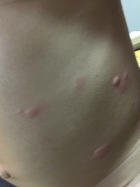 突発性発疹について教えて下さい ７ヶ月の子どもです 日曜の夜から Yahoo 知恵袋