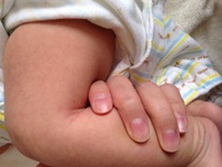 生後2ヶ月の赤ちゃんがいます 手足に毛細血管が浮き出ていますがなにかの病気 Yahoo 知恵袋