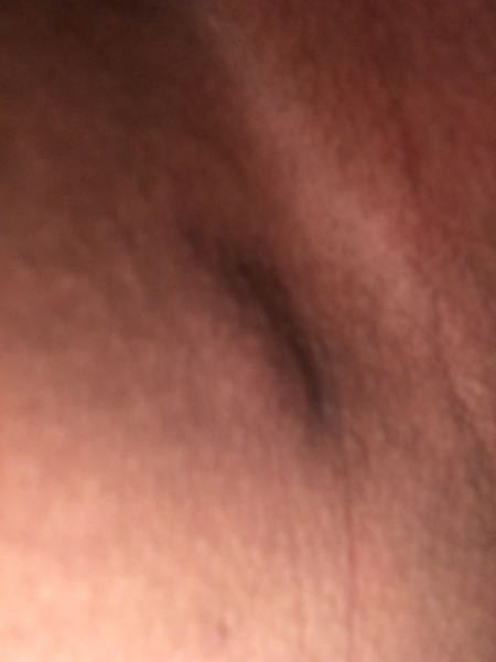 画像あり 高校生女です 右足の付け根 Vラインあたり に Yahoo 知恵袋