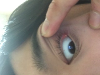 瞼の裏のところに何かできものが出来てしまい 違和感や瞬きの際の痛みなどがあ Yahoo 知恵袋