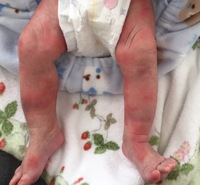 生後1ヶ月の赤ちゃんの足 特にもも辺り 腕 指 お腹 アゴ 顔 Yahoo 知恵袋