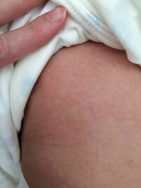 赤ちゃんの乾燥性湿疹に効くスキンケアは 生後７ヶ月の赤ちゃんの母 Yahoo 知恵袋