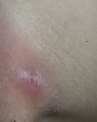 これは粉瘤ですか 毛嚢炎ですか 硬いしこりが股関節左側足の Yahoo 知恵袋