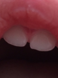 1歳半の歯について 前歯の先端が透明です これは虫歯でしょうか Yahoo 知恵袋