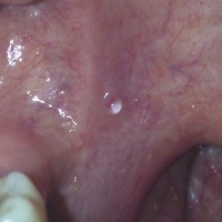 に 口 水疱 中 の 口の中に出来る水ぶくれ3つの原因と対処方法