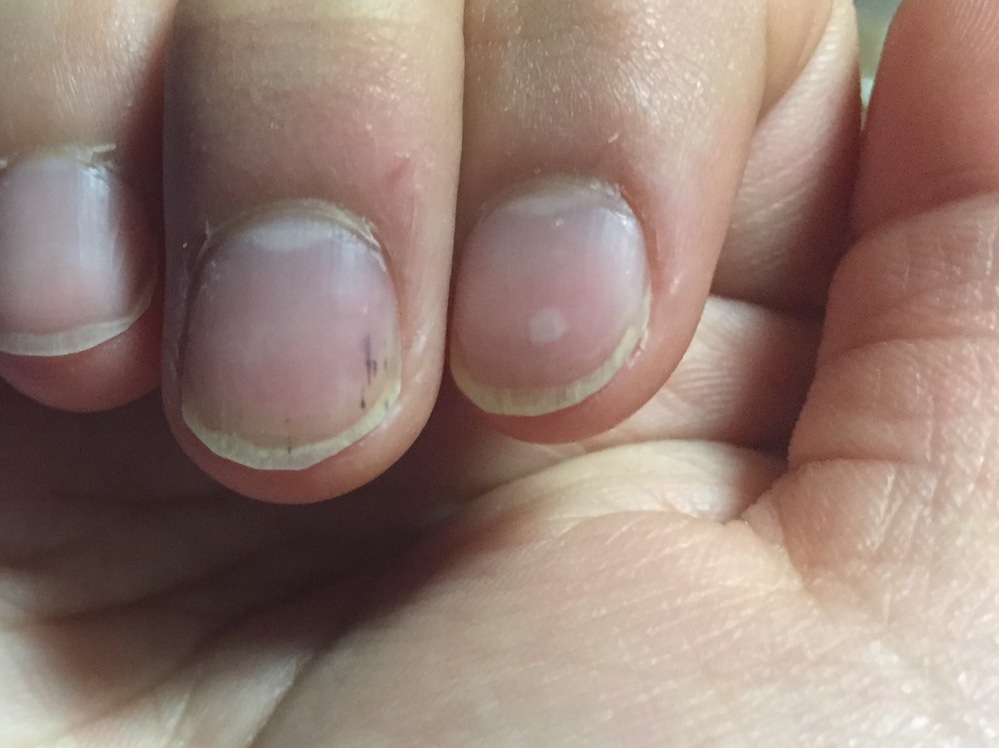 ここからダウンロード 爪 黒い線 栄養不足