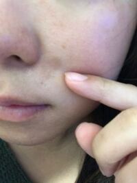 3日前の朝に突然顔の頬の一部に赤いシミのような湿疹のようなものがいきなりで Yahoo 知恵袋