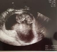 11w2d胎児が小さいです 2週間前の検診ではcrl22mmで 今回 Yahoo 知恵袋