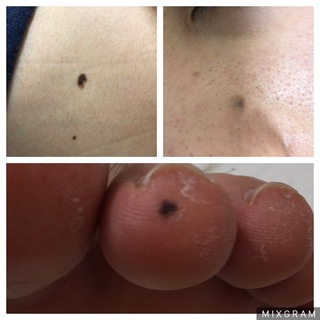 葡萄 嵐 咲く 脇腹 ほくろ Laccsda Org