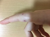 飼い猫に噛まれた後の症状について先週の金曜に指を噛まれてその日に病院で消毒 Yahoo 知恵袋