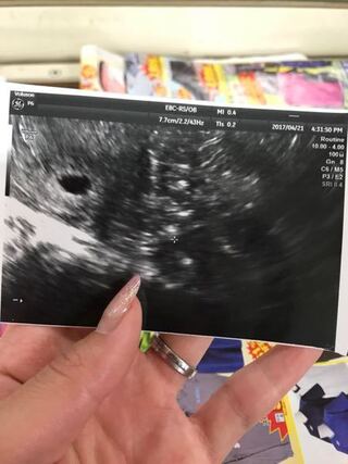 妊娠初期エコーに袋しか映らず心配です まだ妊娠４週目か５週 Yahoo 知恵袋