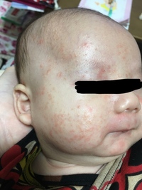 乳児湿疹についてです 生後1ヶ月の息子が居ます 先月の24日あたりから顔に Yahoo 知恵袋