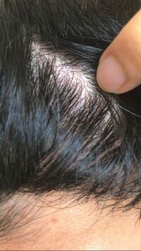 この頭皮は乾燥からきていますか 頭皮が赤く炎症を起こしてい Yahoo 知恵袋