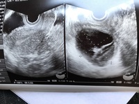 卵巣の腫れが５cmと言われ二週間後に再度受診する予定です このエコーで 卵 Yahoo 知恵袋