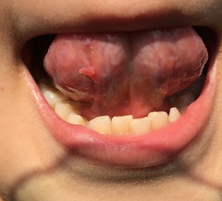 の プチ と した もの に っ 口 中 口腔扁平苔癬って何？？原因と、６つの治療法について