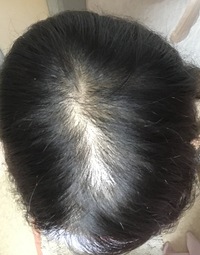 生まれつきの薄毛で悩んでいます 自分で見ても相当な薄毛だと思いますが やは Yahoo 知恵袋