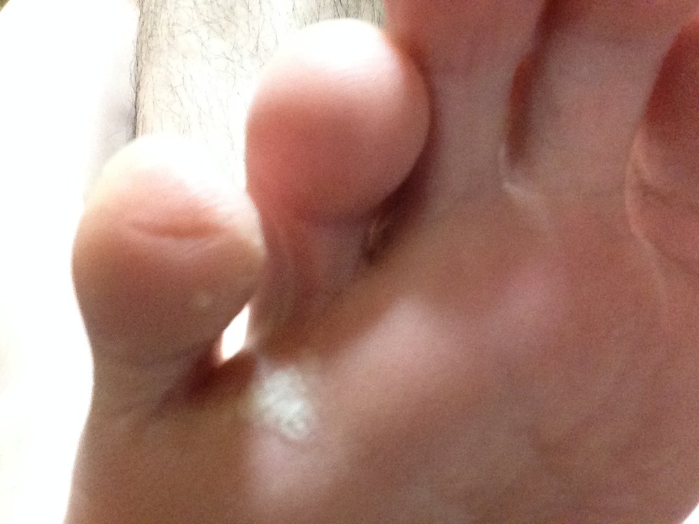 水虫 解決済みの質問 Yahoo 知恵袋