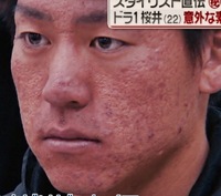 肌にクレーターがあるのにイケメンだと言われる友人は相当イケメン イケメンはだ Yahoo 知恵袋
