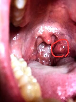 喉に異物感があり鏡でみてみると のどちんこ付近に1cmくらいの赤 Yahoo 知恵袋