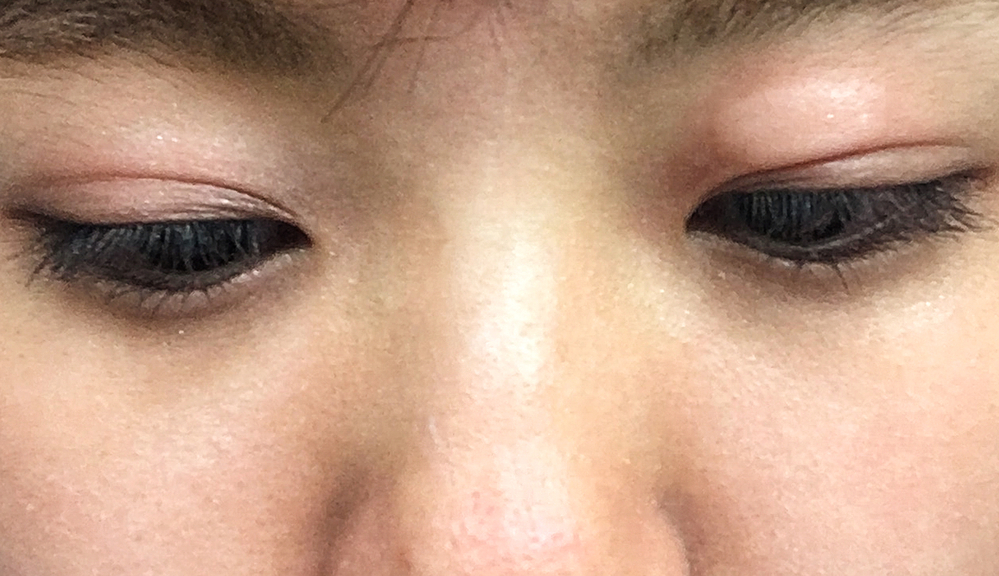 瞼にデキモノができました 突然瞼に小さな虫刺されのような腫れがで Yahoo 知恵袋