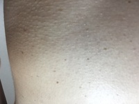 お腹のシミ ほくろ について以前からお腹に画像のようなものが広がっています Yahoo 知恵袋