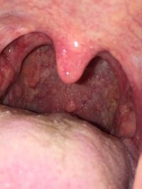 注 画像あり 喉の奥のできものについて 少しまあぐらいから喉に違和 Yahoo 知恵袋