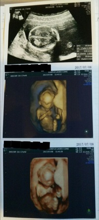 胎児の身長を示すcrlの表示がなくなりました妊娠13週から腹部エコー に変 Yahoo 知恵袋