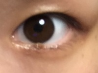 ２日前に 目のキワ 下まつげの生え際 のほくろ除去をしました 皮 Yahoo 知恵袋