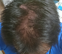 25歳 男で こんな髪薄いってヤバイかな 今すぐ専門員に行か Yahoo 知恵袋