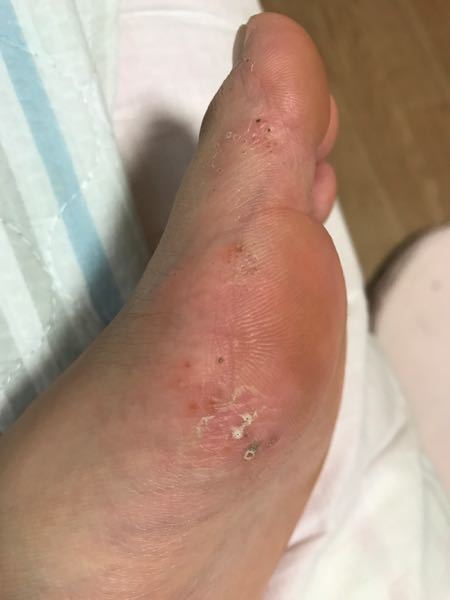 水虫 解決済みの質問 Yahoo 知恵袋