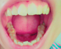 画像あり 中学生女子です 最近歯が痛くて歯の一部が茶色い です これって Yahoo 知恵袋