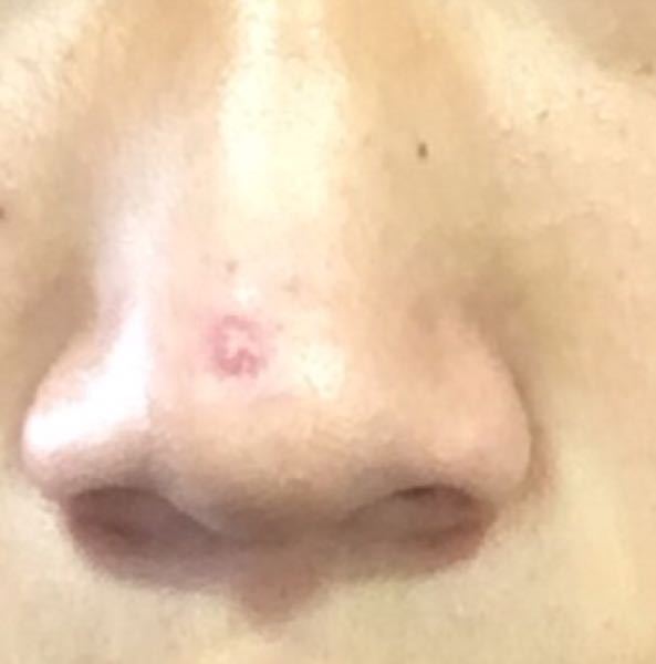 寸法 原理 機転 潰れ た ニキビ Ns Jobs Jp